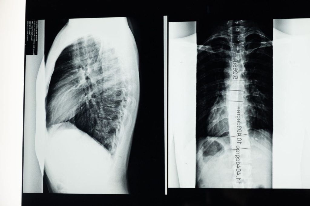 Radiographie haute résolution de la colonne vertébrale montrant une scoliose, pour examen médical détaillé